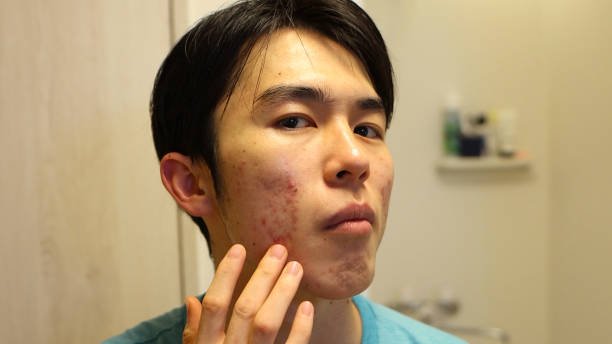 Pimples Treatment Tips to Prevent Frequent Pimples
